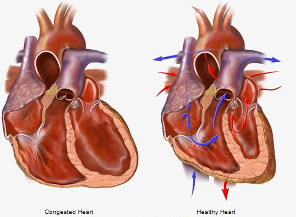 Слабое сердце. Сердечная недостаточность картинные. Сердечная недостаточность фото.